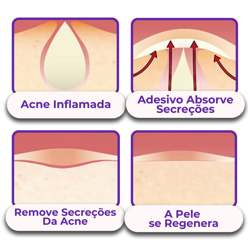 Adesivo Antiacne - Elimine Espinhas sem Marcas em 1 Dia!