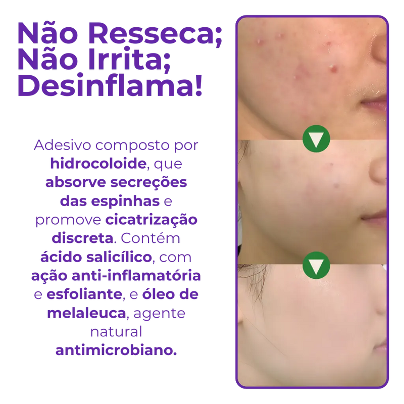 Adesivo Antiacne - Elimine Espinhas sem Marcas em 1 Dia!
